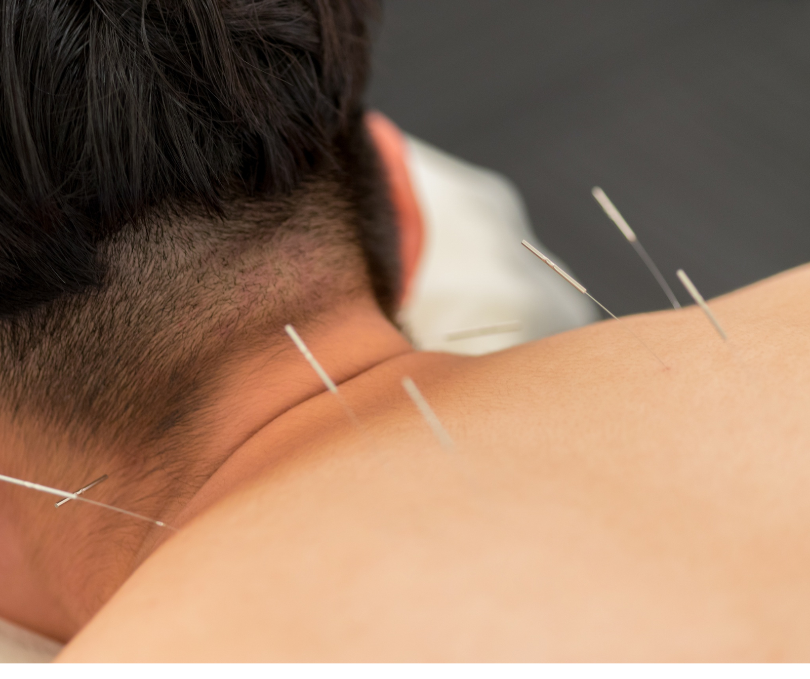 Clinical Acupuncture Therapy | Safe Pain Relief & Healing Care clinical acupuncture therapy