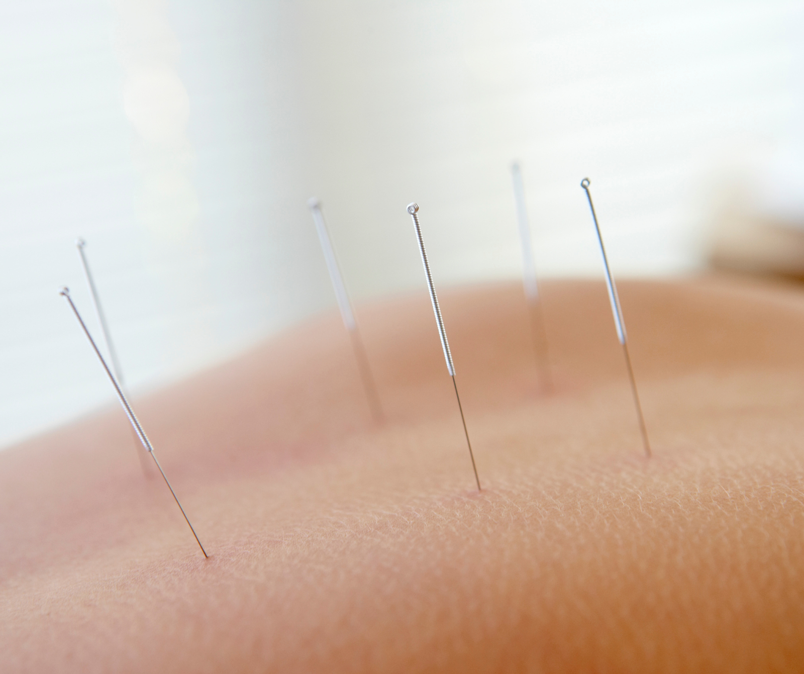 Clinical Acupuncture Therapy | Safe Pain Relief & Healing Care clinical acupuncture therapy