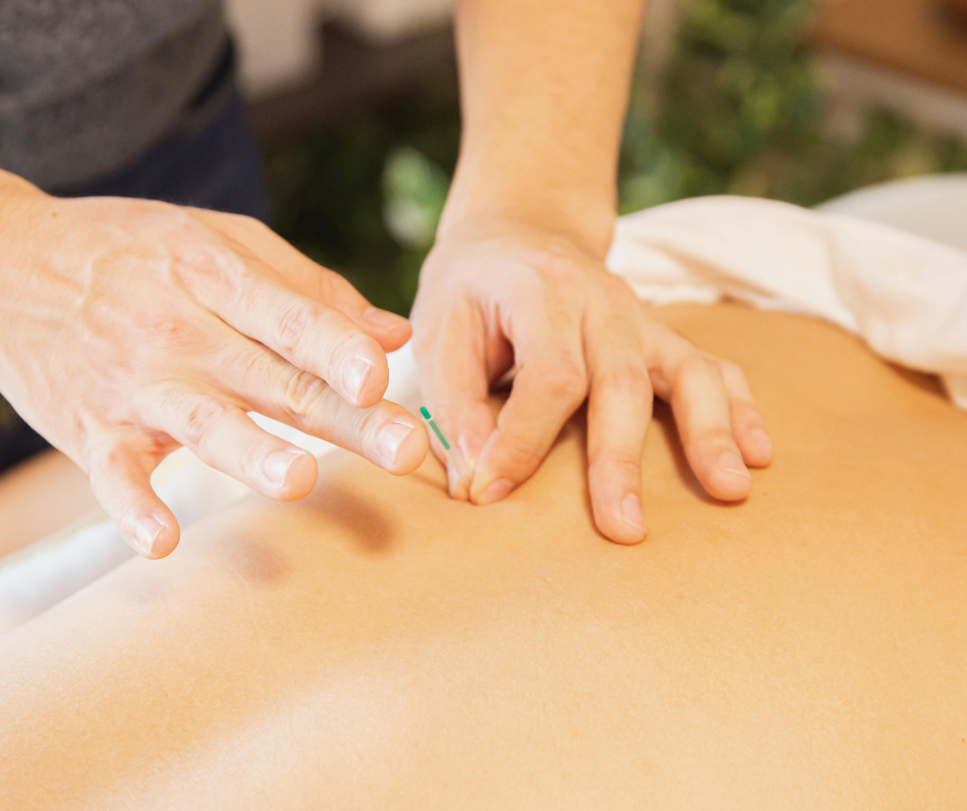 Single Needle Acupuncture Therapy | Precise Holistic Care single needle acupuncture therapy