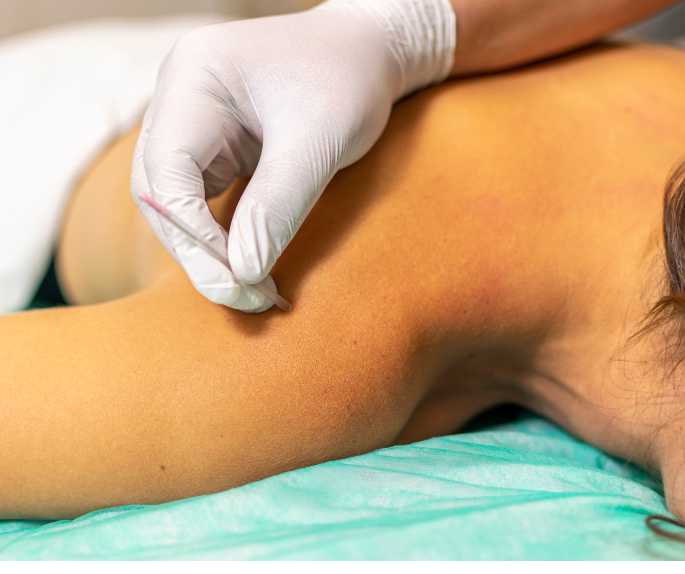 Single Needle Acupuncture Therapy | Precise Holistic Care single needle acupuncture therapy