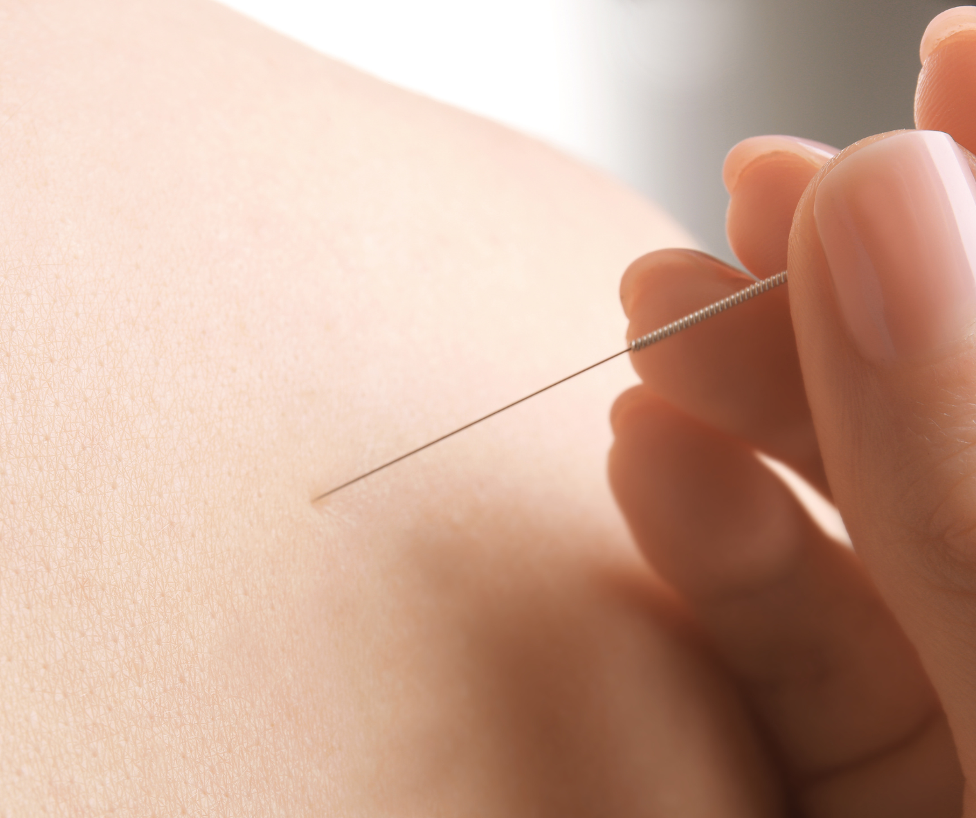 Single Needle Acupuncture Therapy | Precise Holistic Care single needle acupuncture therapy